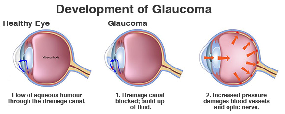 Development of Glaucoma